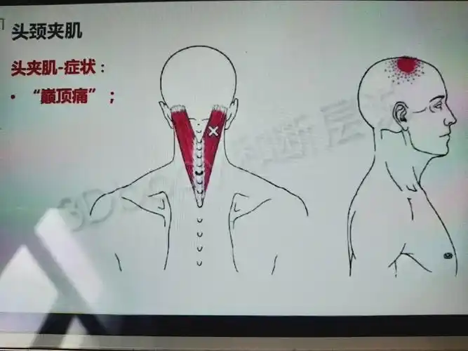 头颈夹肌及手法.