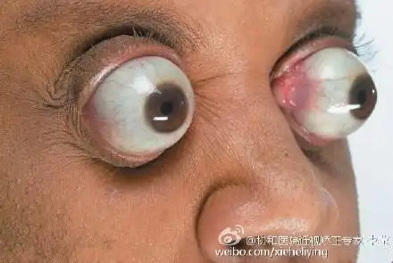 从临床来看,眼球突出是所有近视眼患者的共同毛病,有些人虽然表面看不