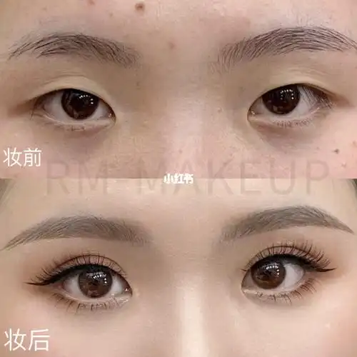 大眼术单眼皮秒变双眼皮78