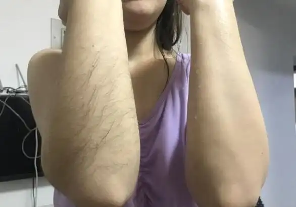 体毛多的女生怎么才能持久脱毛呢
