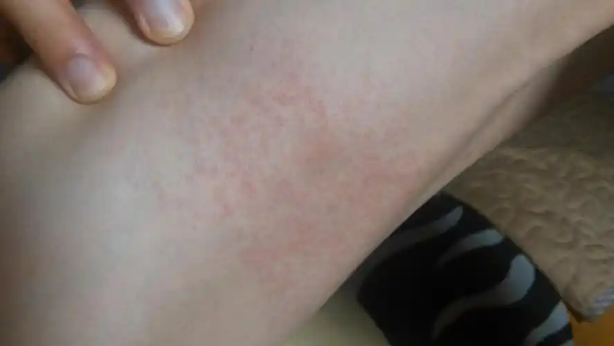 前几天出去喝了酒后来之后第二天在身上有些挠过之后变得又红又痒