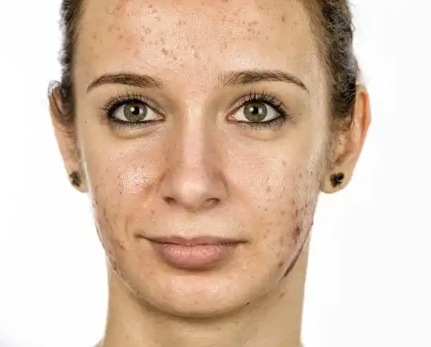 粉刺图片素材_图片id:149030652