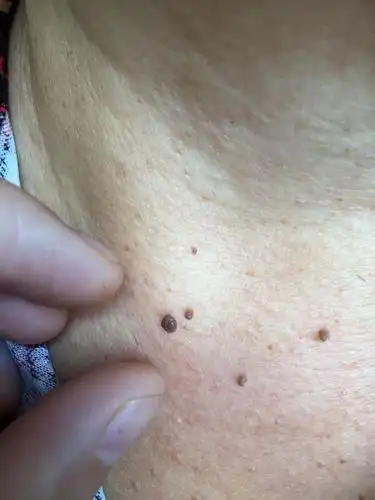 惊奇的发现脖子上长了很多肉色或者褐色的小"瘊子",以为会传染给宝宝