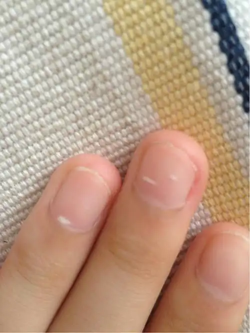 指甲上的白点大概什么,最严重时十个手指甲上都会有.