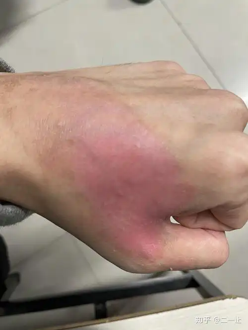 手被开水(100度)烫伤恢复全过程(ps:附带我的做法以及正确处理方法)