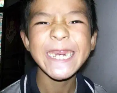 由于血铅含量超标  7岁的张明明牙齿都没有长齐