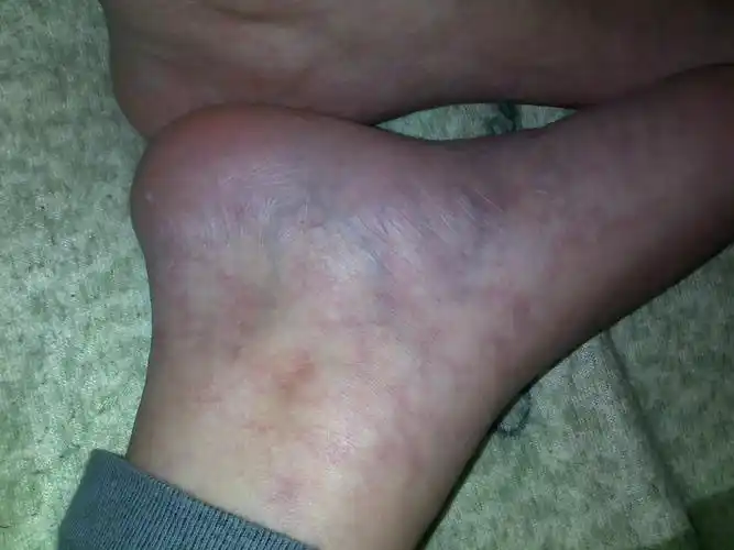 医生回答:脚上为什么有红血丝,平躺时就没有了.