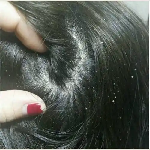 冬季头皮痒头皮屑多用什么洗发水?