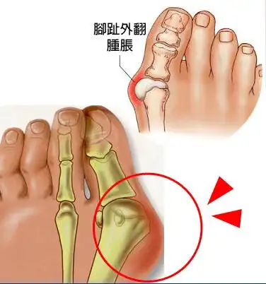 大脚骨的发生主要由什么引起来的