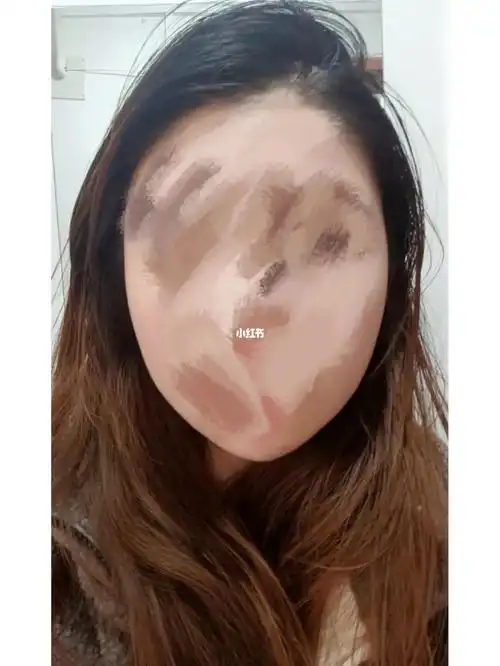 拔智齿一个月了脸凹陷仍然还没有恢复