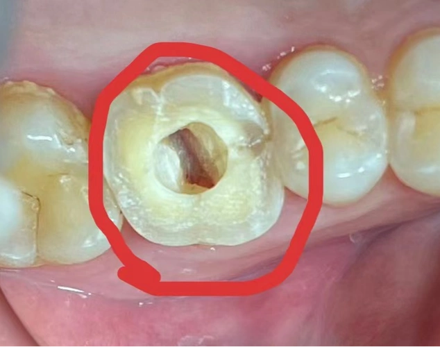 上颌第一磨牙(如图2)又明显多于上颌第二磨牙.