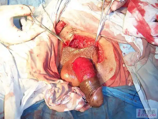 外科区 69 泌尿及生殖医学专业讨论版 69 【病例报告】老年男性