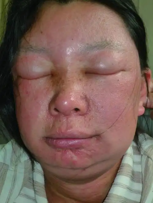 皮肤性病科图谱病毒性皮肤病传染性单核细胞增多症