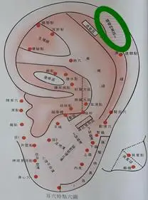 肿瘤特异区Ⅱ耳穴诊治法具有"诊,治,防"及操作简单,经济,安全,有效