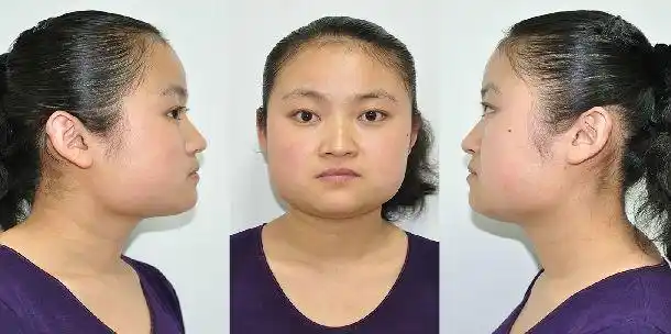 口外微创无疤痕方脸改型手术效果(最新多图) - 好大夫在线