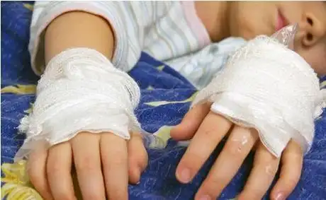 三岁女童弄伤手指奶奶用创可贴包扎医生手指坏死要截指