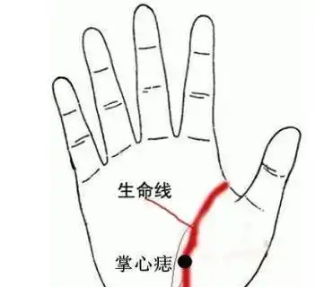 掌中纹路有痣看运势,哪些痣象征了一生好运,招财进宝,你有吗?