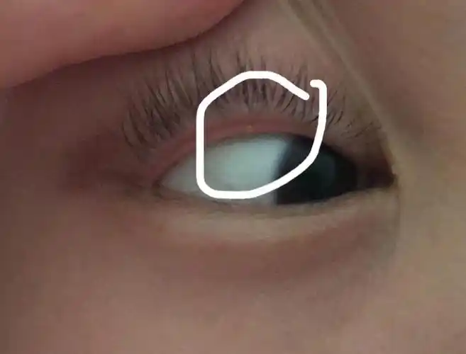 上眼皮翻开有一个透明泛黄色的小泡 我妈非说是麦粒肿 让我忍着  但是