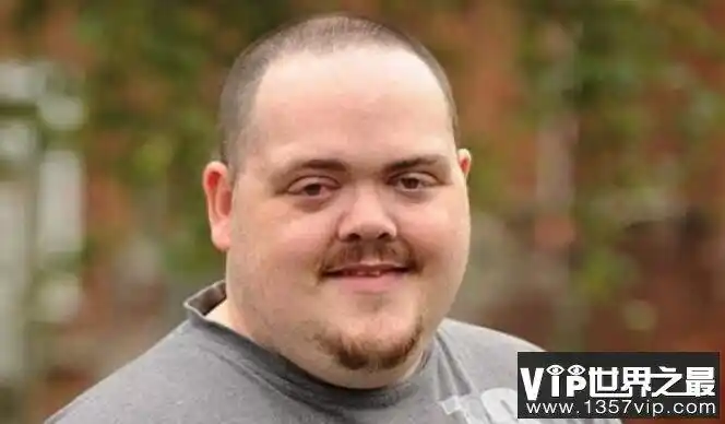 世界上眼球最突出的人:约翰·道尔,眼睛凸出12毫米