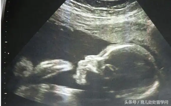 b超单子上有男女暗示吗?教你如何看胎儿性别