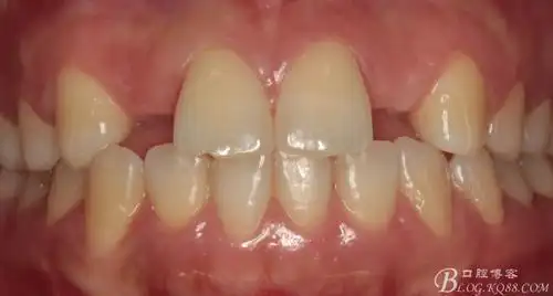 两个侧切牙的数字化美学种植修复--*完结篇**&