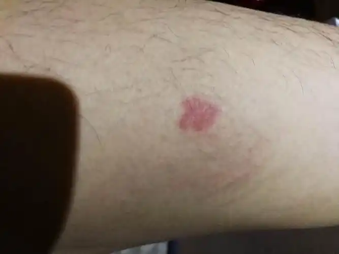 朋友腿上突然张红色斑点,这是怎么回事?