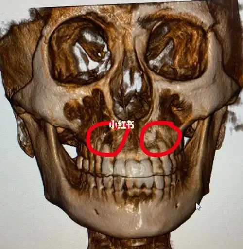 虎牙又长又强壮的牙根对鼻翼基底的支撑有举足轻重的作用(图一虎牙和4