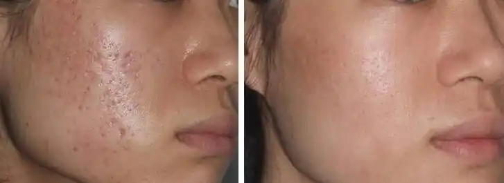 去痘印医院哪家好