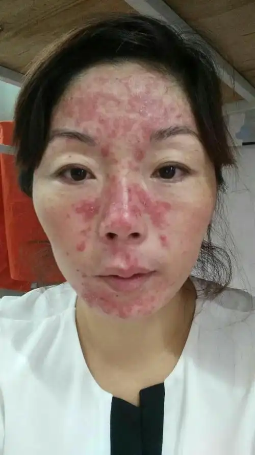 去正规医院检查治疗才对 追问 治了,没好 医院说是毛囊虫皮炎,药也吃