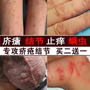 周阴囊大腿内侧瘙痒反复性湿疹股癣外用药膏赛博朗医疗器械旗舰店