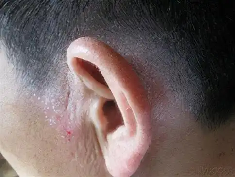 青少年脂溢性皮炎如何根治(青少年头皮脂溢性皮炎能根治吗)