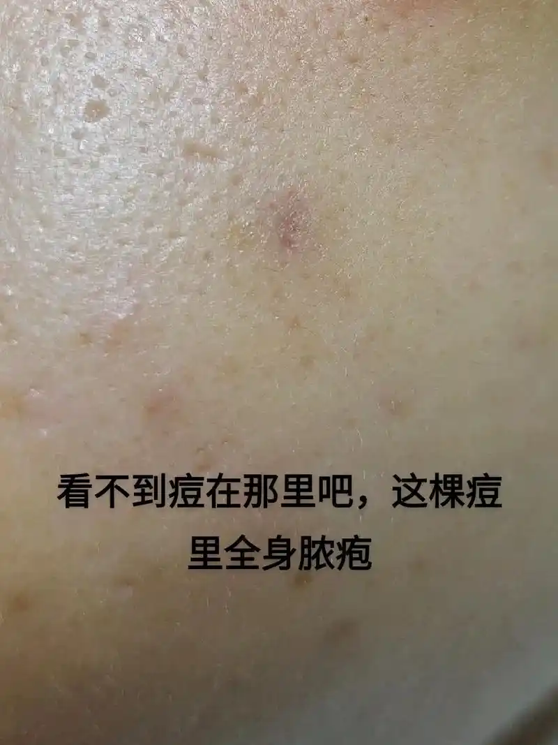 痘痘 #美白 #油性皮肤 你有痘吗?#解压  - 抖音