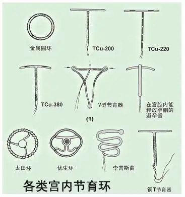 绝经后被遗忘在身体里的节育环,可能是一颗定时炸弹