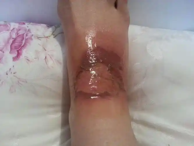 脚背烫伤需要植皮吗