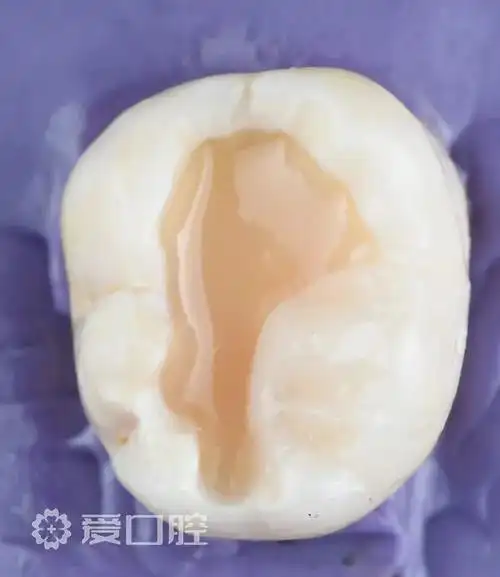 下颌第一磨牙一类洞树脂分层充填欣赏