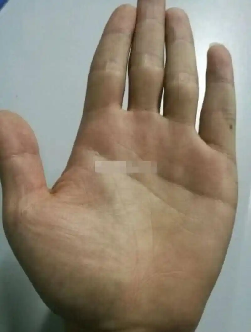 金星丘有横纹,表明你的身体消化不好,需要注意肠胃问题,感情线呈现