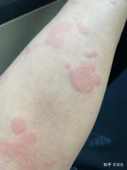 打新冠疫苗后 皮肤过敏 - 知乎