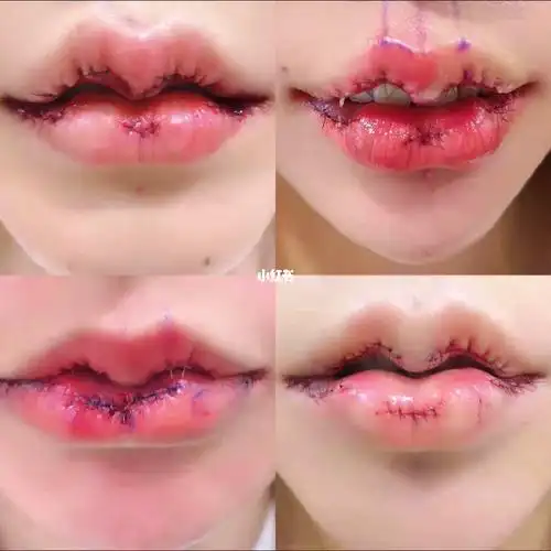 微笑唇,_微笑唇_嘟嘟唇_美妆_医美整形