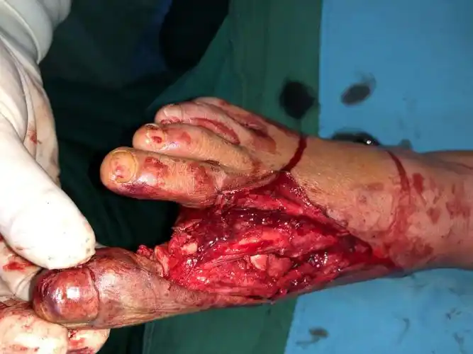 清创皮肤边缘,清除无血运骨组织,韧带撕裂,复位骨折镜下一一找出神经