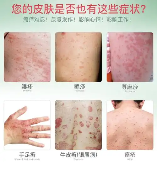 成人湿疹止痒去根股藓股癣膏大腿内侧牛皮癣药膏外用皮肤汗疱疹_找券