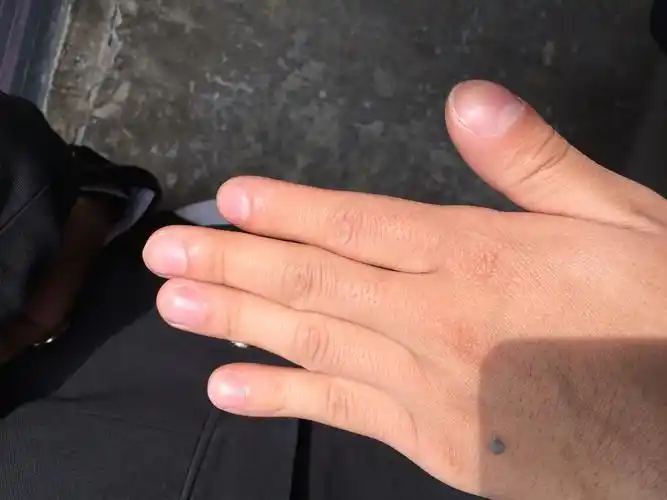 你好我手指头很大每根都很大从小好像就是这样子请问是什