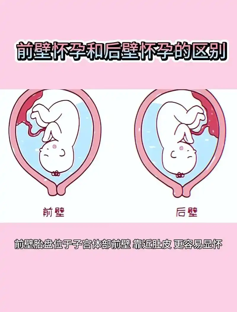 90前壁胎盘:位于子宫体部,前壁靠近肚皮,更容易显怀,可能会出现肚子
