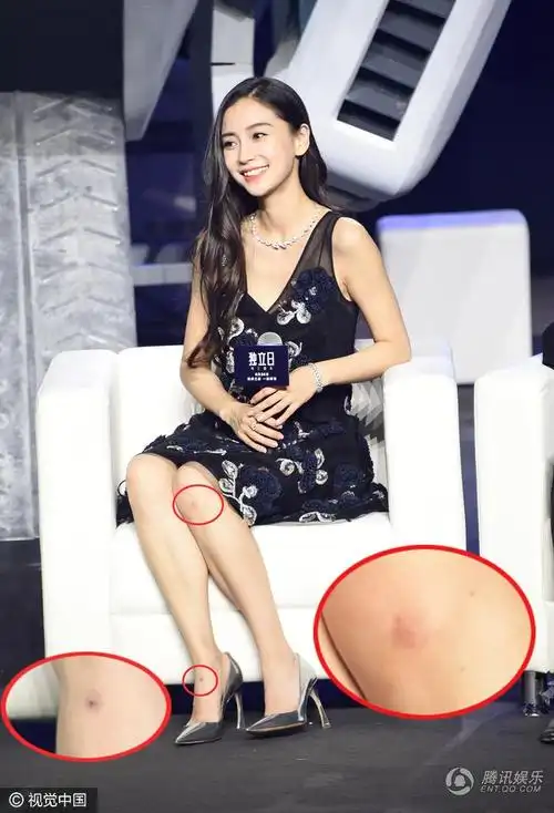 baby腿上惊现多处伤痕 与导演罗兰拥抱贴脸送吻