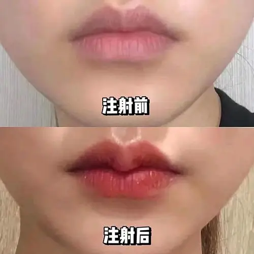 95一直都有想法do嘴唇的,而且看到嘟嘟唇_圈子-新氧美容整形