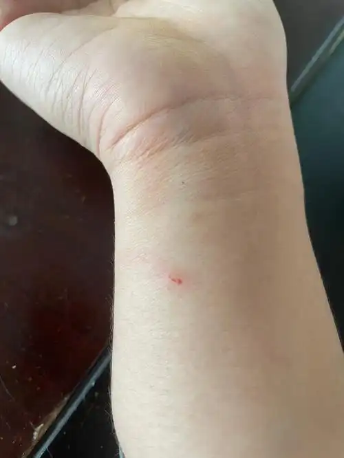 被家里猫咪咬了