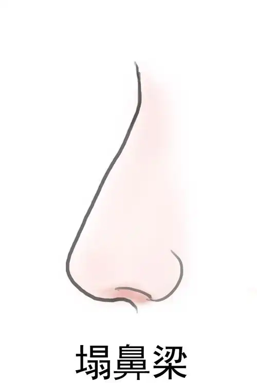 p>人们常说的塌鼻梁,又称 a href="#" data-lemmaid="6021122">鞍鼻