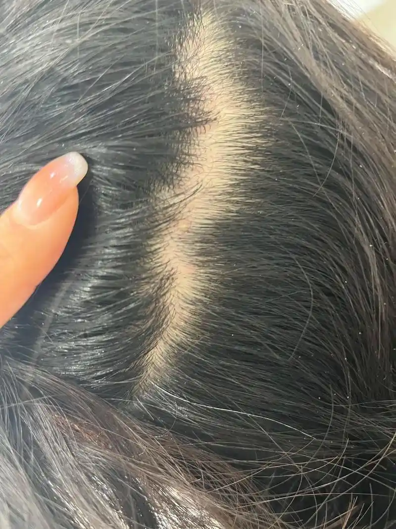 头痒头屑头皮长痘最后导致大量脱发