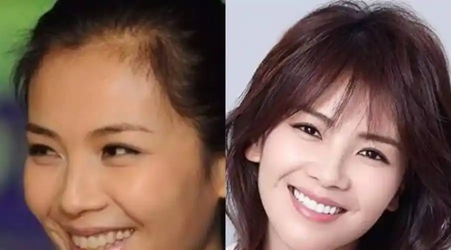 明星整牙如整容,她一口牙竟然消费300万?