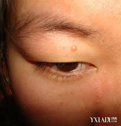 图眼皮长了个小肉粒切莫大意这三种情况