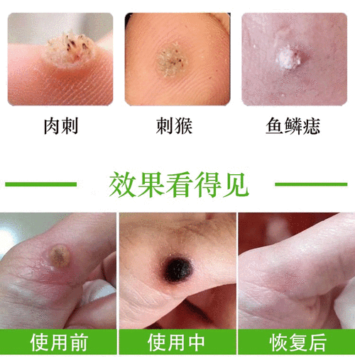 去猴子肉粒疙瘩贴净鱼鳞去除膏手部足部祛正品刺猴专用